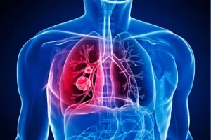 Guédiawaye : 68 cas de tuberculose enregistrés au mois de janvier 2024