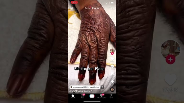 (Vidéo) – La main abimée de cette fille de 19 ans causée par le « Khessal » fait le buzz