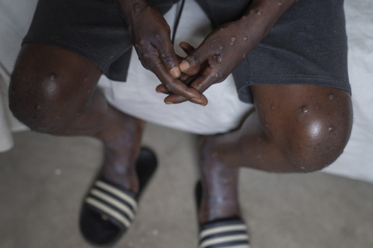 Mpox: le premier cas en Asie accroit les craintes d'une propagation mondiale