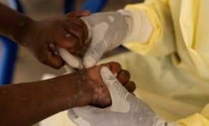Sénégal : le dispositif de surveillance du mpox déployé au niveau national