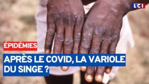 Présence de la variole du singe au Sénégal : Dr Boly Diop, responsable de la surveillance épidémiologique dément l’information