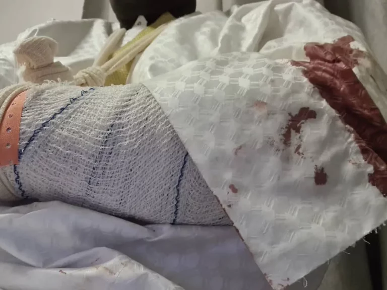 Malick Gakou gravement blessé avec une fracture ouverte lors de l’attaque du cortège de Sonko à Koungheul (Photos)