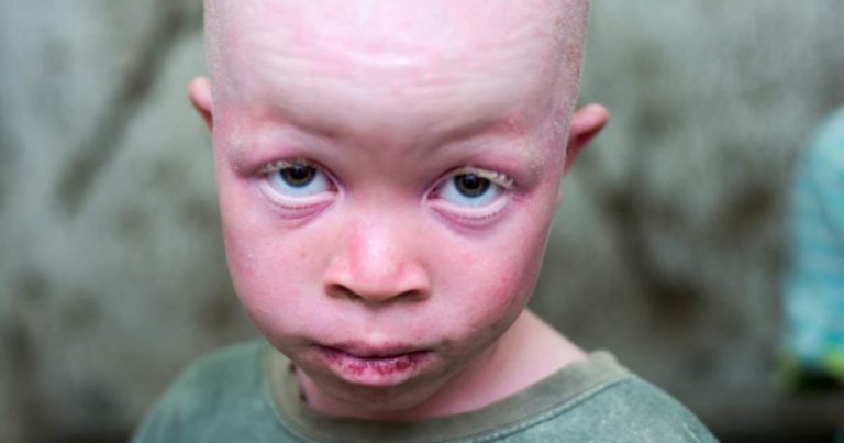 Les albinos toujours marginalisés malgré la loi de 2010, alerte l’ANAS