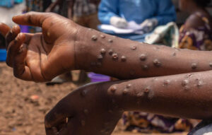 Mpox et Fièvre de la Vallée du Rift : Le Sénégal face à deux épidémies