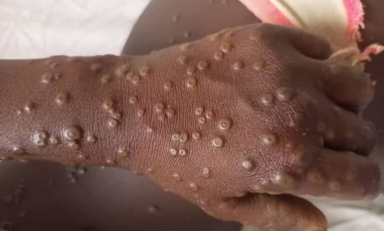 Santé : un deuxième cas de Mpox confirmé à Dakar, 20 contacts identifiés